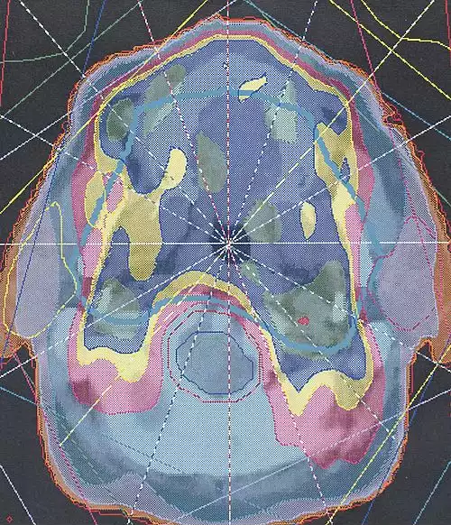 پرتودرمانی