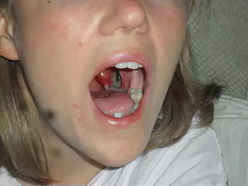 لوزه برداری