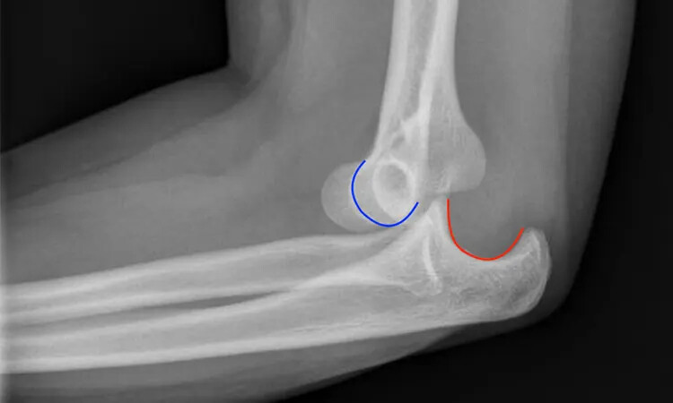 دررفتگی بسته